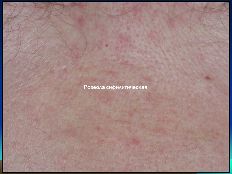 Розеола сифилитическая